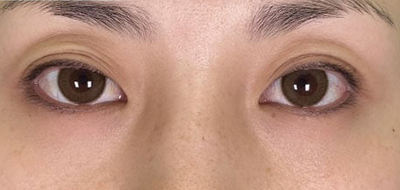 二重整形 症例写真 before